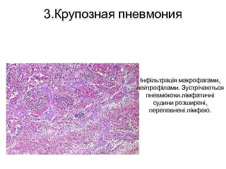 3. Крупозная пневмония Інфільтрація макрофагами, нейтрофілами. Зустрічаються пневмококи. лімфатичні судини розширені, переповнені лімфою. 