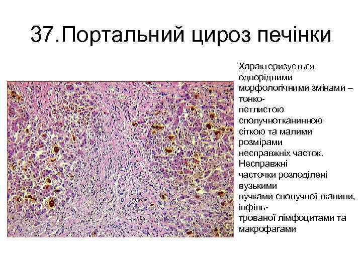 37. Портальний цироз печінки Характеризується однорідними морфологічними змінами – тонкопетлистою сполучнотканинною сіткою та малими