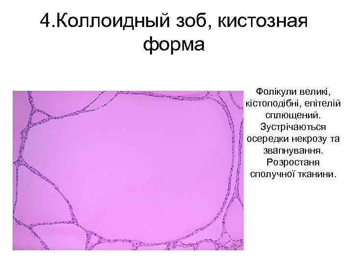 Цитологическая картина зоба с кистозной дегенерацией