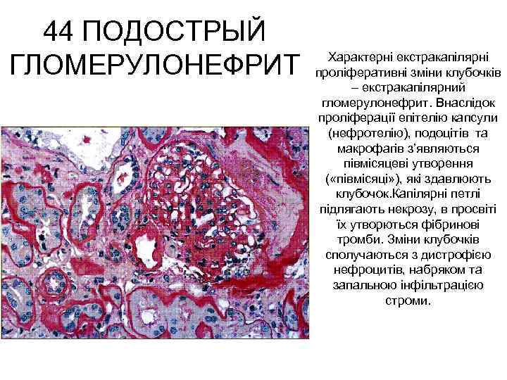 Микроскопическая картина мочи при гломерулонефрите