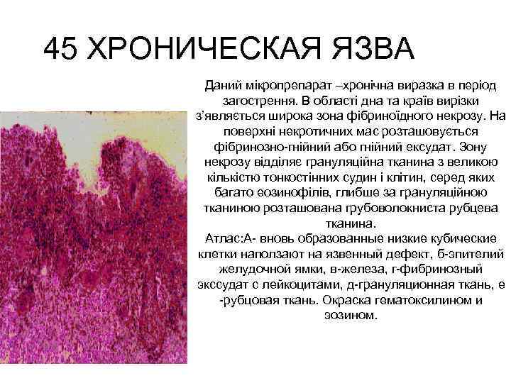 Хроническая язва желудка микропрепарат рисунок