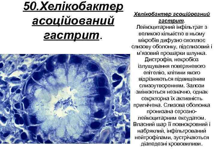 50. Хелікобактер асоційований гастрит. Лейкоцитарний інфільтрат з великою кількістю в ньому мікробів дифузно охоплює
