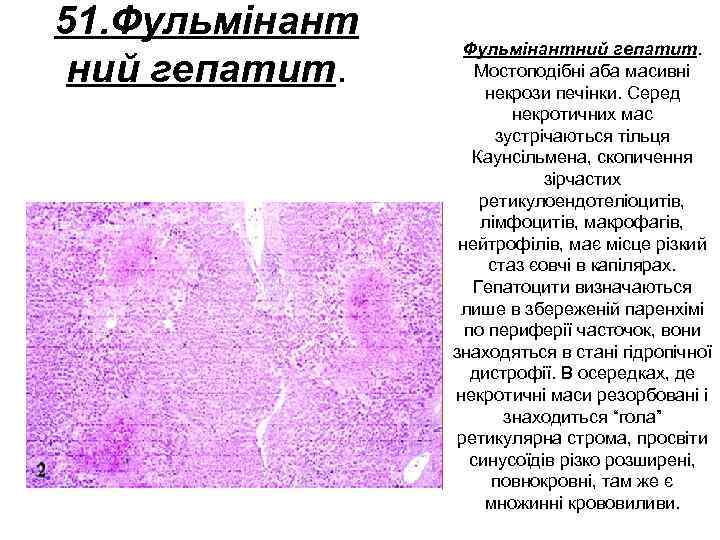 51. Фульмінант ний гепатит. Фульмінантний гепатит. Мостоподібні аба масивні некрози печінки. Серед некротичних мас
