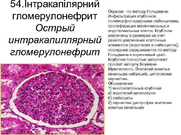 Острый гломерулонефрит микроскопическая картина