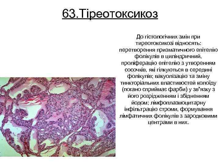 63. Тіреотоксикоз До гістологічних змін при тиреотоксикозі відносять: перетворення призматичного епітелію фолікулів в циліндричний,
