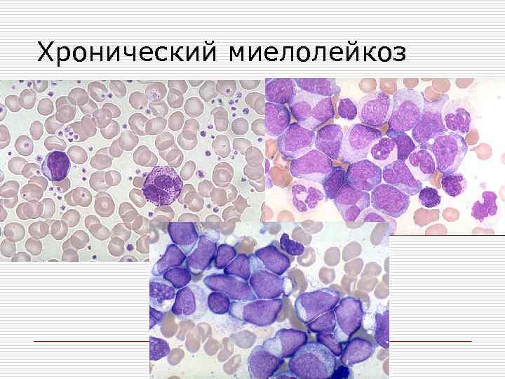 Хронический миелолейкоз 