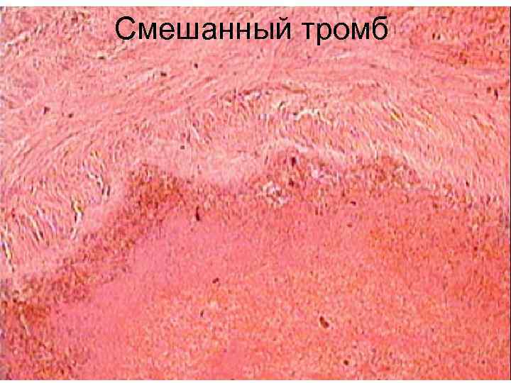 Смешанный тромб 