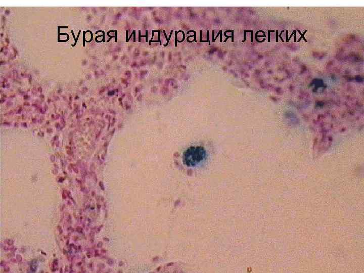 Бурая индурация легких 