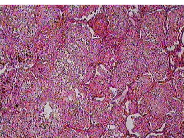 Крупозная пневмония 