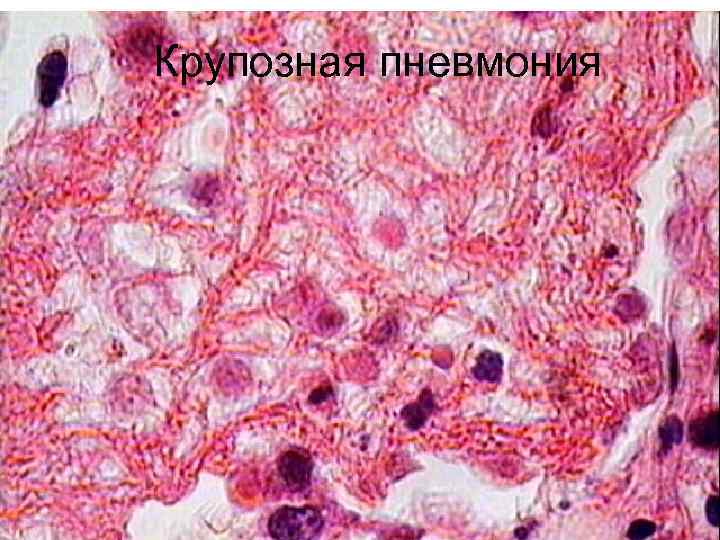 Крупозная пневмония 