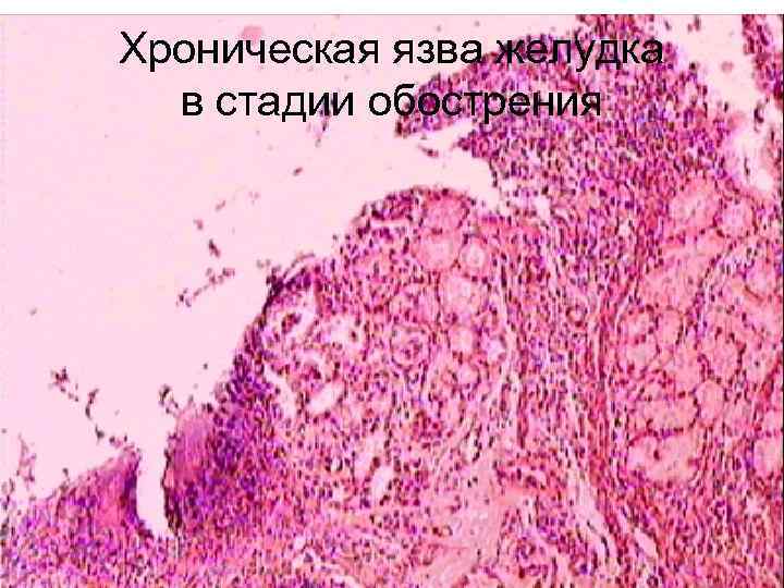 Хроническая язва желудка микропрепарат рисунок