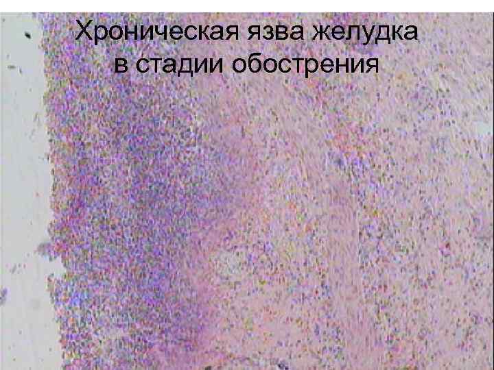 Хроническая язва желудка в стадии обострения 