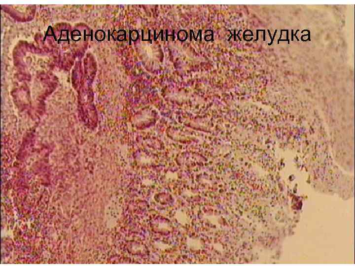 Аденокарцинома желудка 