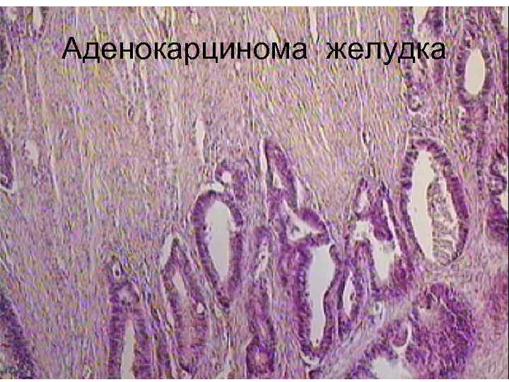 Аденокарцинома желудка 