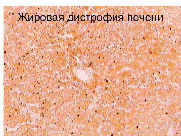 Жировая дистрофия печени 