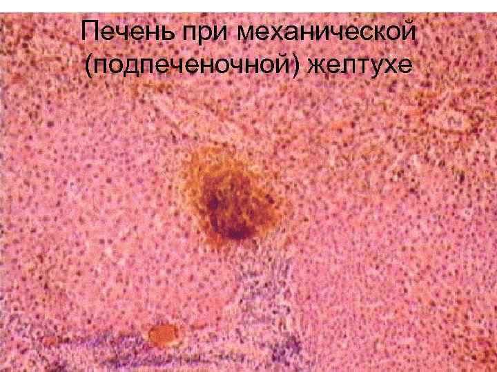Печень при механической (подпеченочной) желтухе 