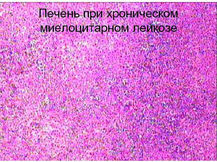 Печень при хроническом миелоцитарном лейкозе 