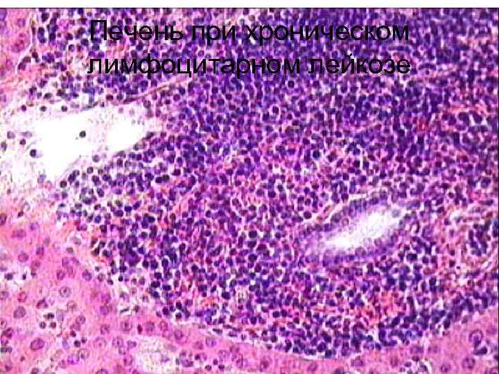 Печень при хроническом лимфоцитарном лейкозе 