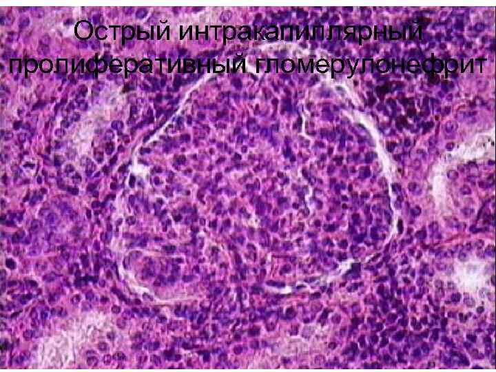 Острый интракапиллярный пролиферативный гломерулонефрит 