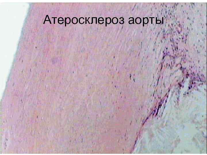 Атеросклероз аорты 