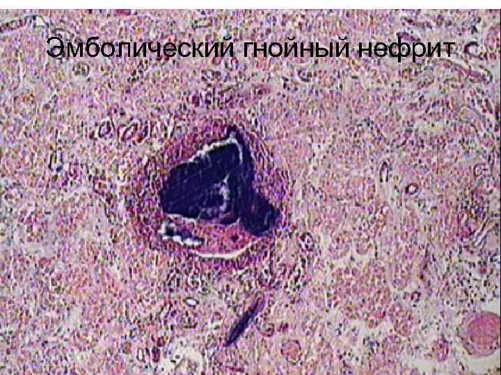 Эмболический гнойный нефрит микропрепарат рисунок