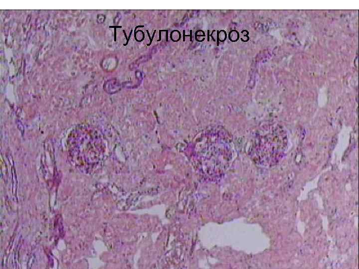Тубулонекроз 