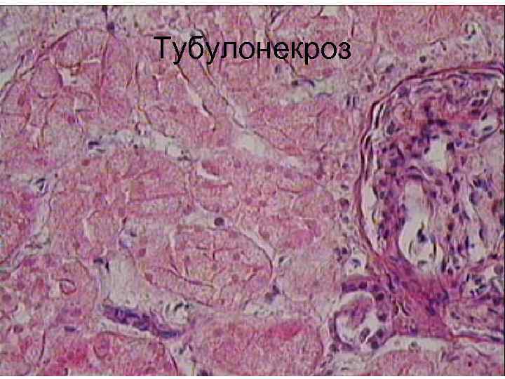 Тубулонекроз 