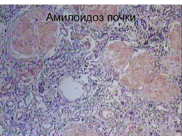 Амилоидоз почки 