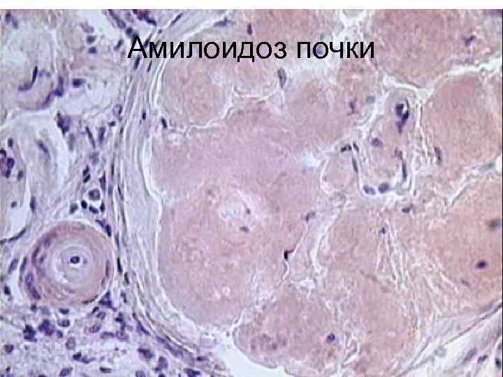 Амилоидоз почки 