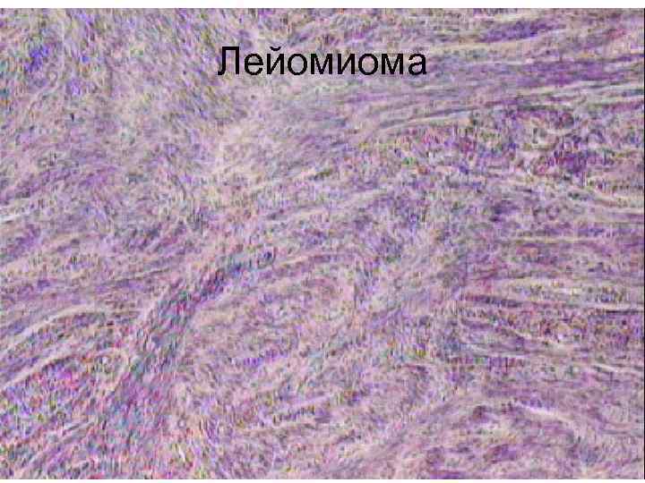 Лейомиома 