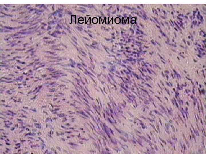 Лейомиома 