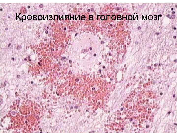Кровоизлияние в головной мозг 