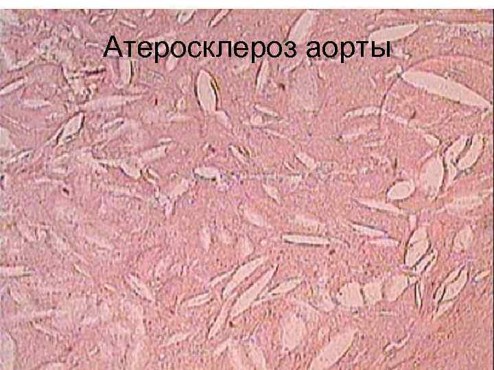 Атеросклероз аорты 