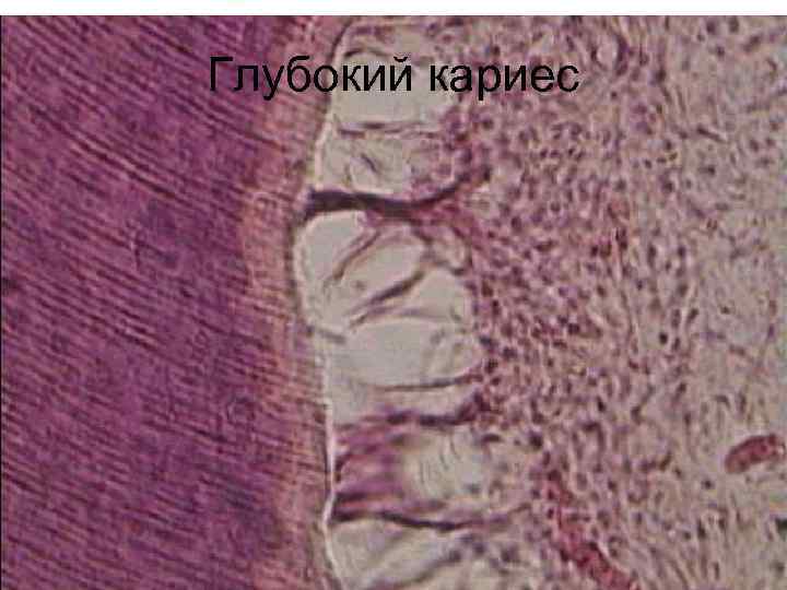 Глубокий кариес 