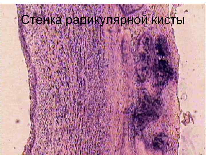 Стенка радикулярной кисты 