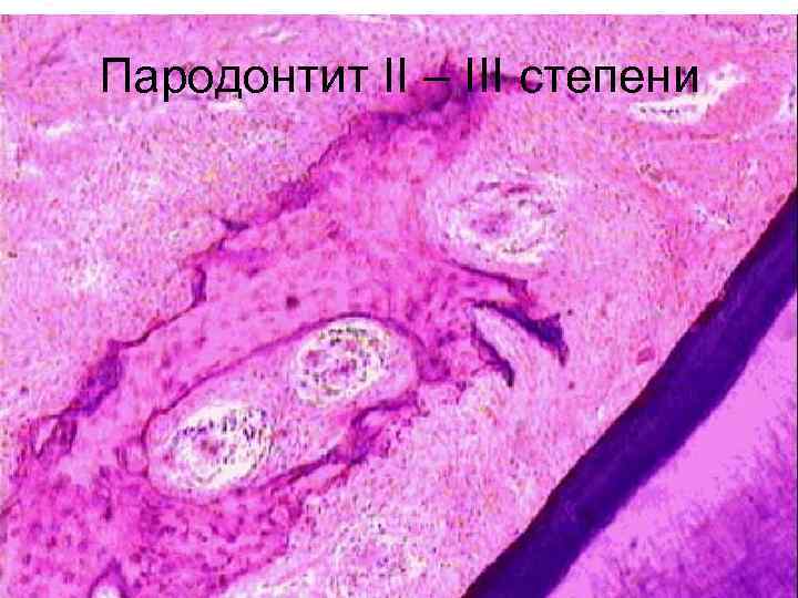 Пародонтит II – III степени 