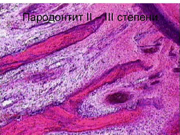 Пародонтит II – III степени 