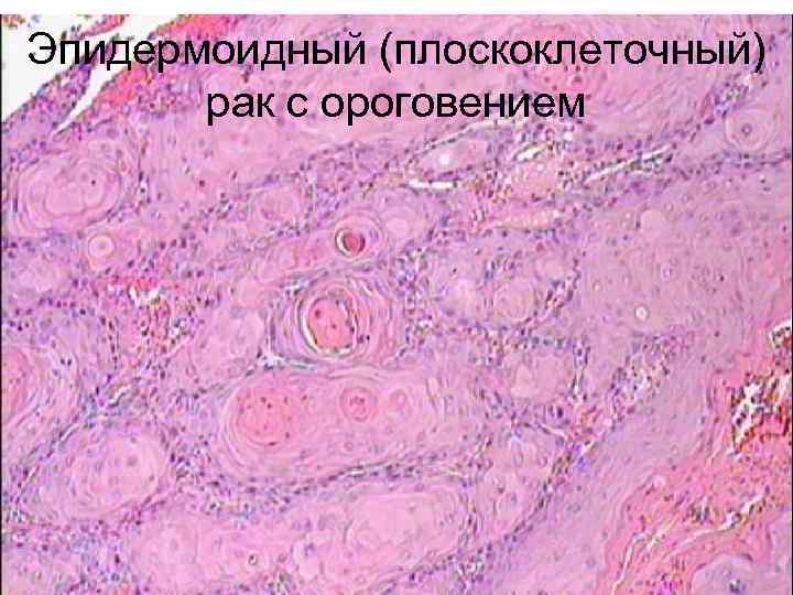 Плоскоклеточный Кожи Фото