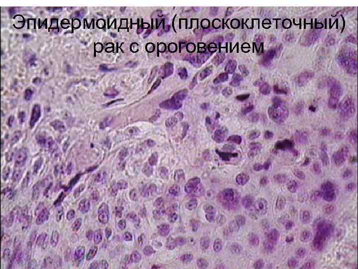 Эпидермоидный (плоскоклеточный) рак с ороговением 