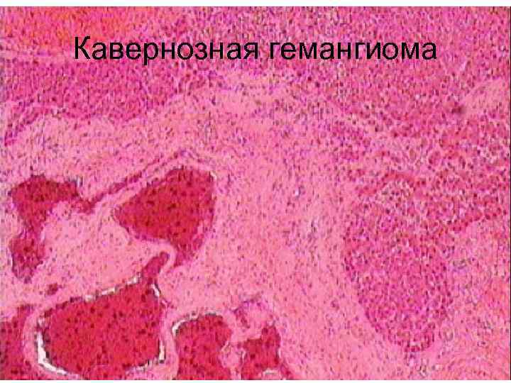 Кавернозная гемангиома 