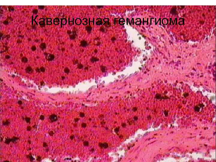 Кавернозная гемангиома 