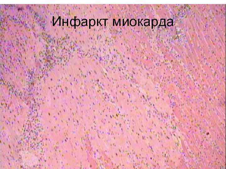 Инфаркт миокарда 