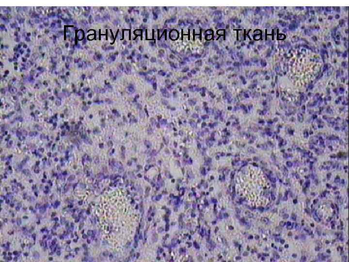 Грануляционная ткань 