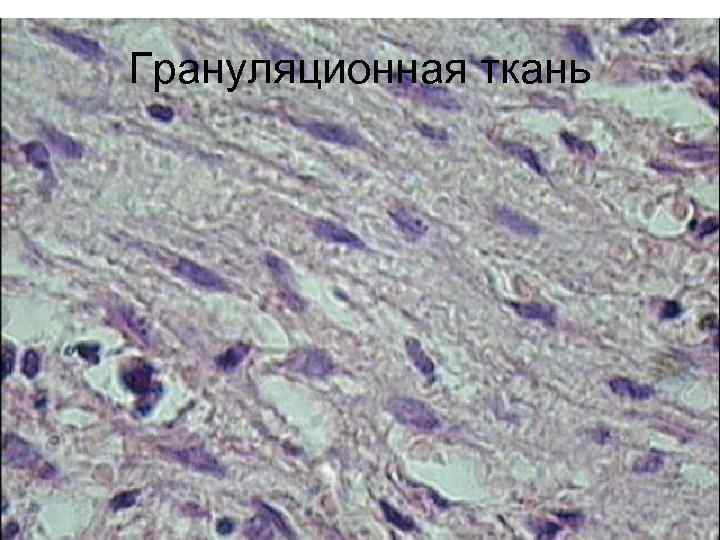 Грануляционная ткань 