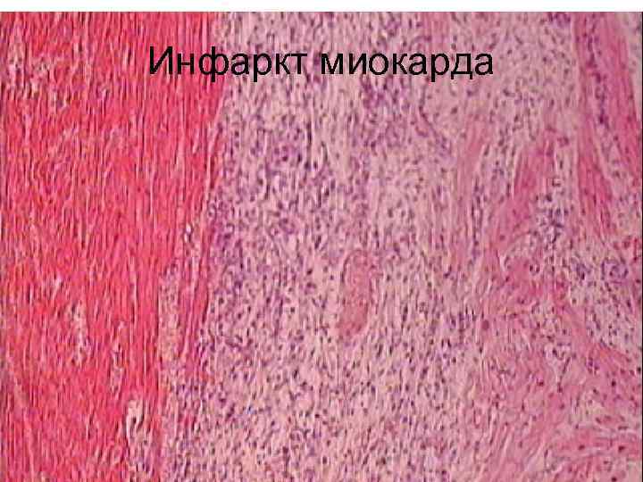 Инфаркт миокарда 