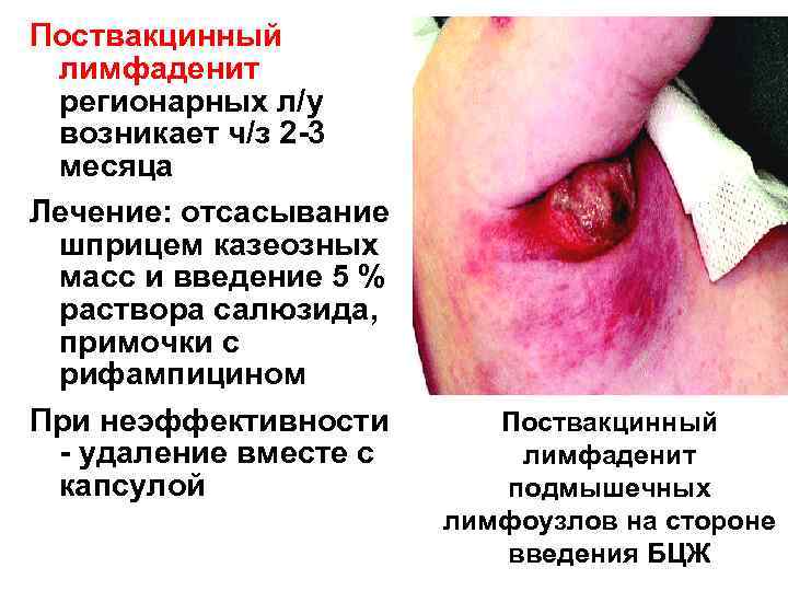Поствакцинный лимфаденит регионарных л/у возникает ч/з 2 -3 месяца Лечение: отсасывание шприцем казеозных масс