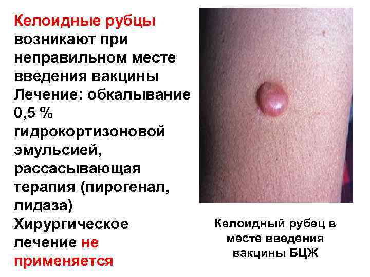 Келоидные рубцы возникают при неправильном месте введения вакцины Лечение: обкалывание 0, 5 % гидрокортизоновой
