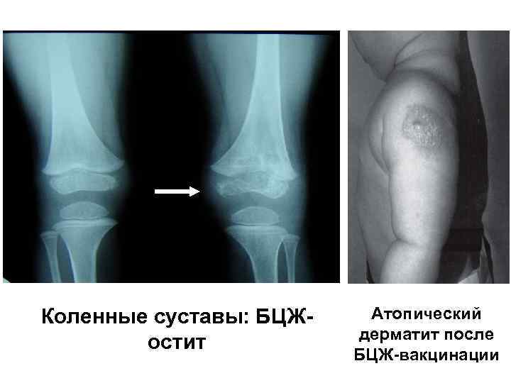 Коленные суставы: БЦЖостит Атопический дерматит после БЦЖ-вакцинации 