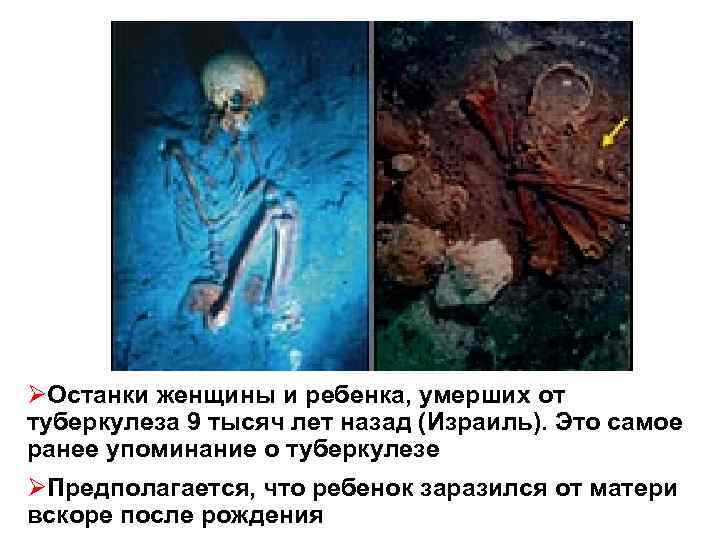 ØОстанки женщины и ребенка, умерших от туберкулеза 9 тысяч лет назад (Израиль). Это самое
