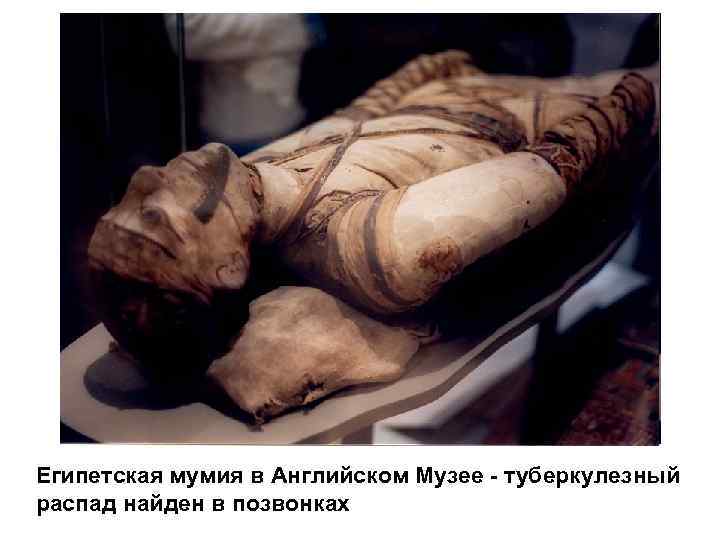 Египетская мумия в Английском Музее - туберкулезный распад найден в позвонках 